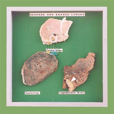 Smoker's Lung Object Box